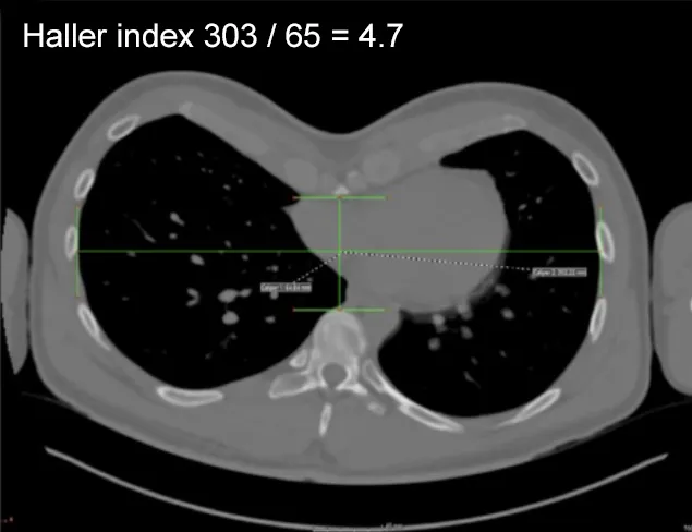 JF Chest CT scan pectus excavatum